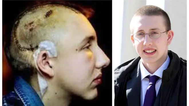 Alfie Meadows' injuries (left) and in 2012 when he was cleared of causing violent disorder