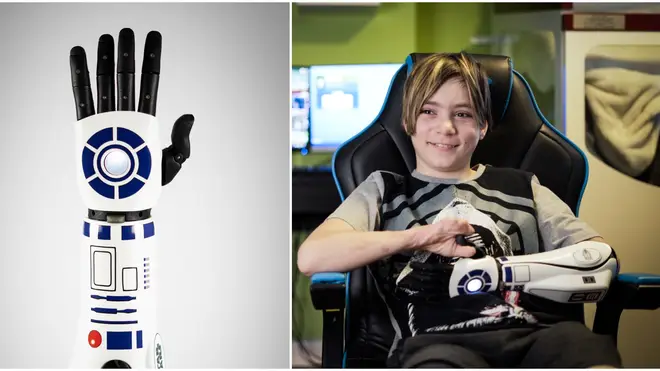 Kye Vincent became the first person to receive an R2-D2 bionic arm