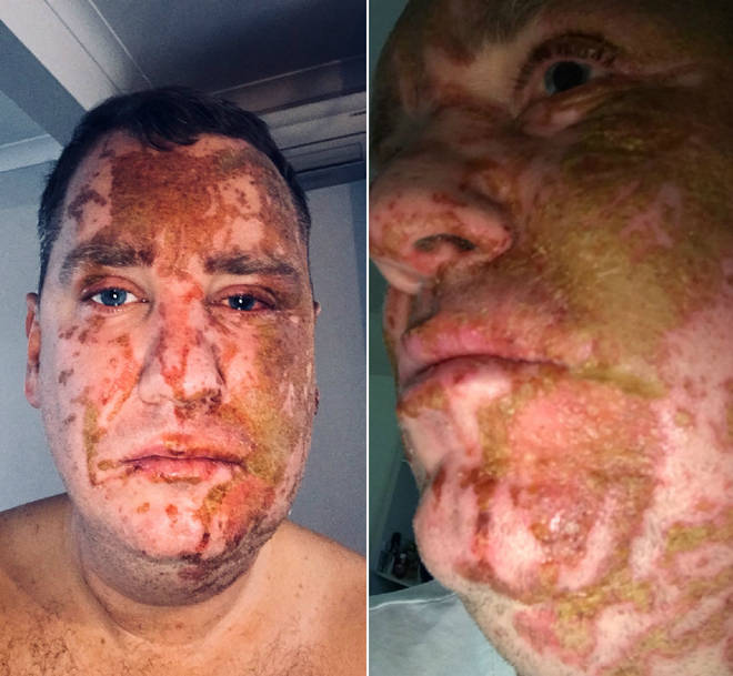 Acid attack victim Andrew Walker