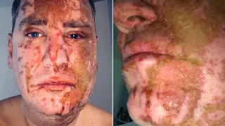 Acid attack victim Andrew Walker