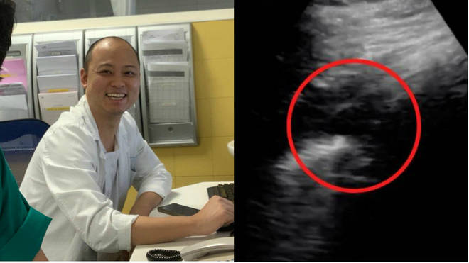 Yale Tung Chen (left) released a daily diary with ultrasounds (right) showing the effect the virus had on his lungs
