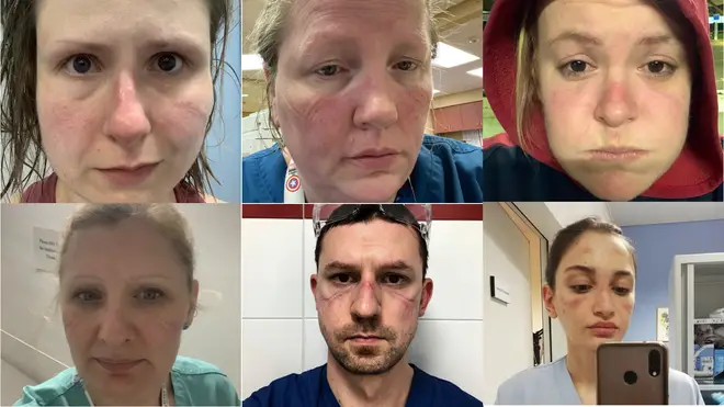 Healthcare workers have been sharing selfies showing indents and sores created by protective gear after long working hours