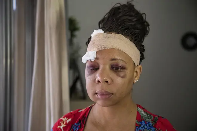 LaToya Ratlieff suffered a cracked skull after a rubber bullet hit her head in Fort Lauderdale while she was protesting peacefully