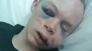 The injuries suffered by Callum Wade in the unprovoked attack