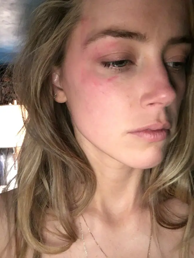 Undated picture shown in court of injuries said to have been sustained by Amber Heard in an alleged incident in May 2016 when Johnny Depp is said to have thrown a phone at her