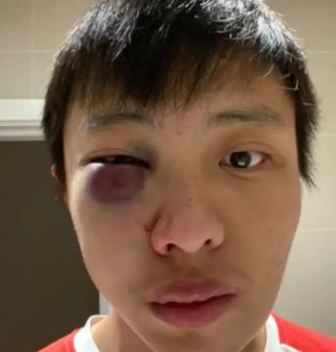Jonathan Mok needed surgery after the attack