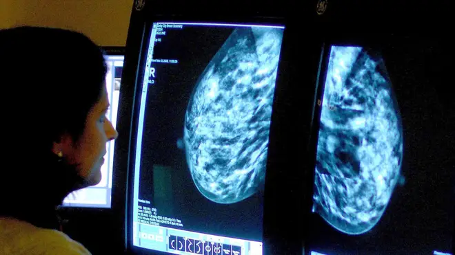 Breast Cancer Now calculated that 10,700 fewer people were diagnosed with breast cancer between March and December 2020 than it would have expected