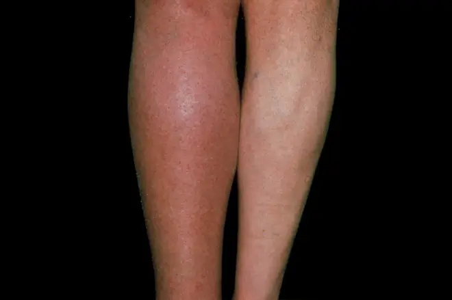 Swelling and redness caused by a clot in the left leg