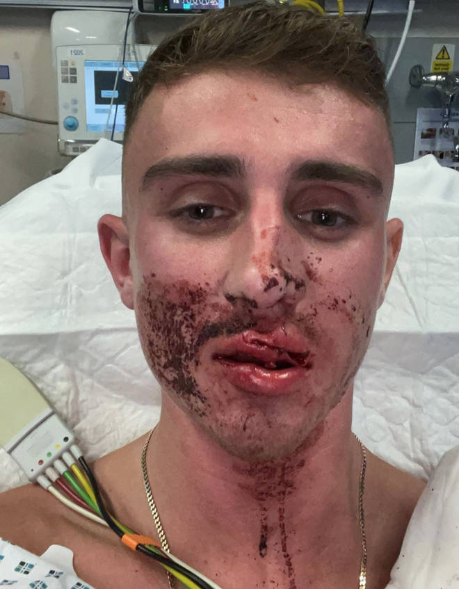 GRAPHIC: Jack Woolley shows his social media followers the injuries sustained