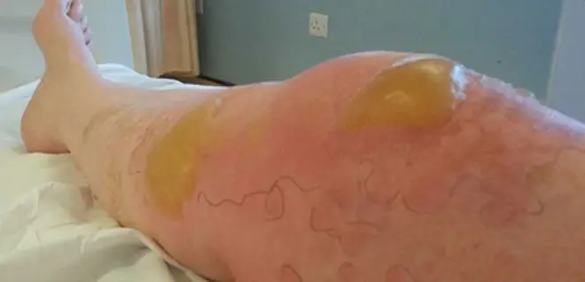 Blisters Caused By Giant Hogweed. Photo: National News