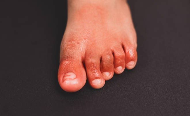 A new study has given fresh insight into the skin condition known as 'COVID toes'