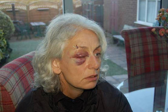 The injuries suffered by dog handler Diane Irving