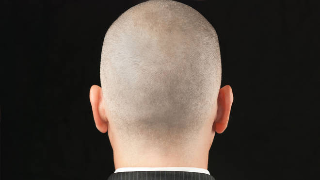The three-person panel was asked to decide whether calling someone bald is an insult or amounted to harassment