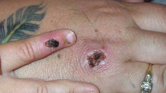 Monkey Pox Lesions