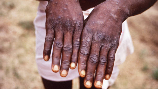 Monkeypox is very rare and causes mild-symptoms in most people