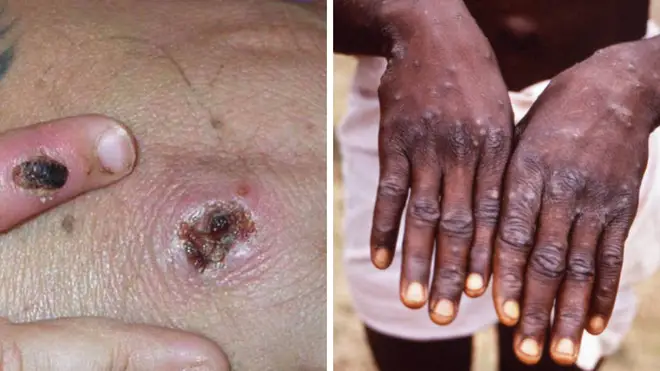 Europe has been warned to take "great care" as further cases of monkeypox are diagnosed in Spain and Portugal