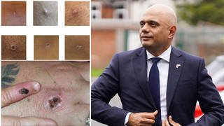 Eleven new cases of monekypox have been confirmed in the UK