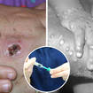Some people are being offered the smallpox vaccine, which has effectiveness against monkeypox.