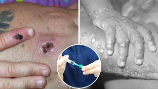 Some people are being offered the smallpox vaccine, which has effectiveness against monkeypox.
