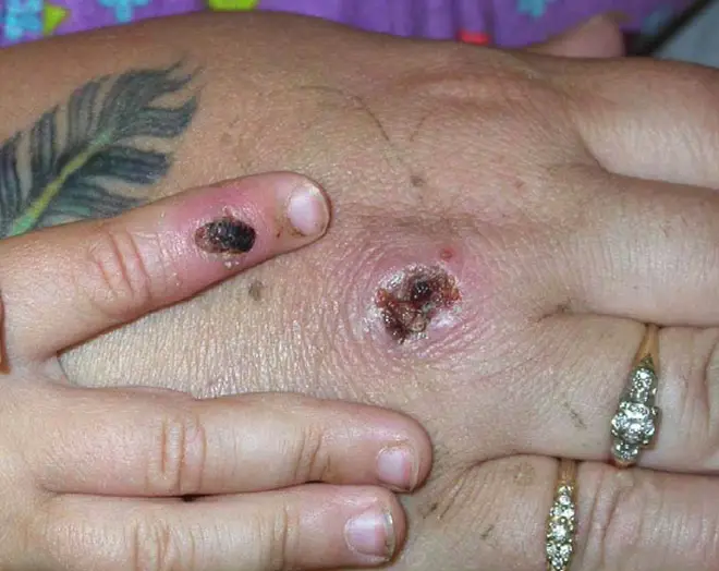 Monkeypox can lead to scabs.