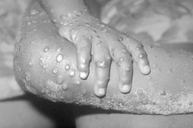 Monkeypox cases are spreading in the UK.