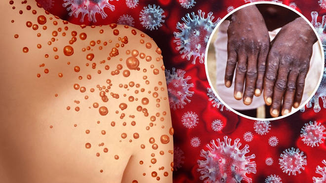 There are now 57 cases of monkeypox in the UK