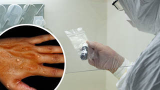 UK monkeypox cases has passed 100
