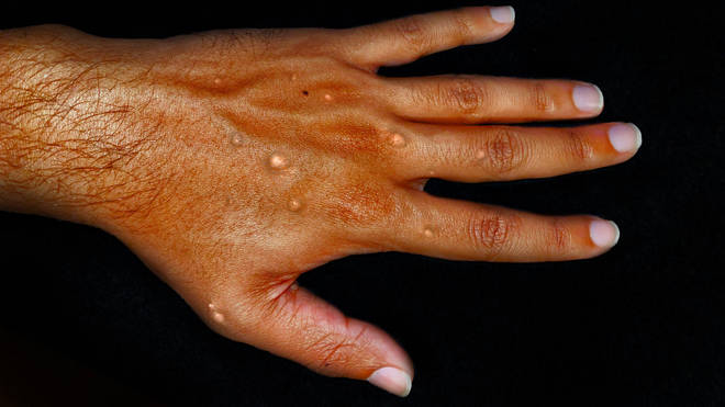 Monkeypox symptoms include rashes and lesions
