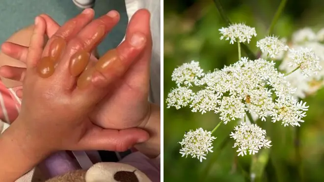 A four-year-old girl suffered horrific burns from a giant hogweed plant in Bolton.