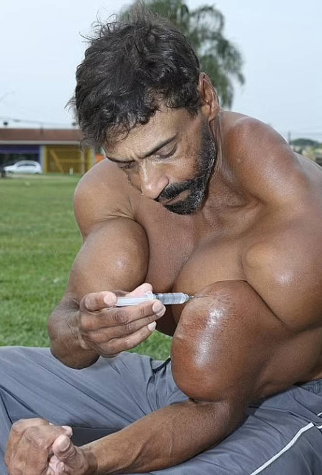 Valdir was fond of synthol injections despite warnings against it