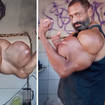 The bodybuilder was warned about taking synthol injections