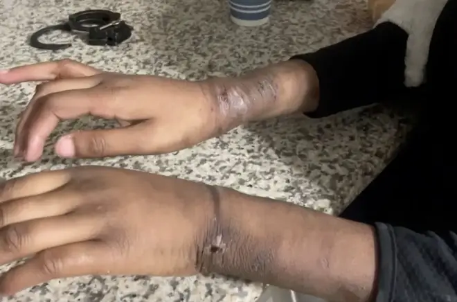 One of the children's wrists injured by the handcuffs