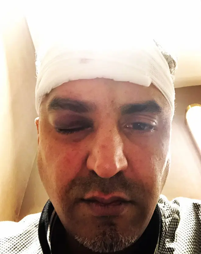 Maajid Nawaz after receiving treatment following his attack
