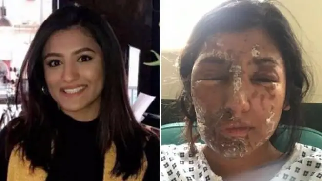 Resham Khan, who was the victim of the acid attack in east London 