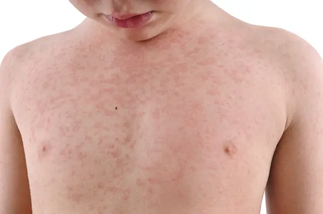 A child with a measles rash