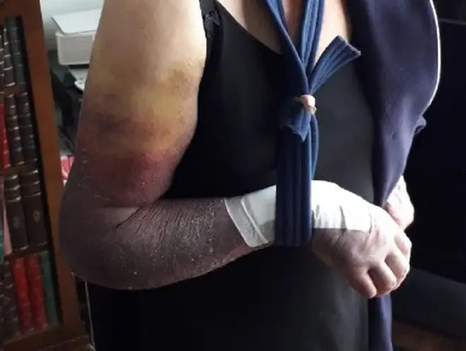 The pensioner's arm was broken during the brutal attack.