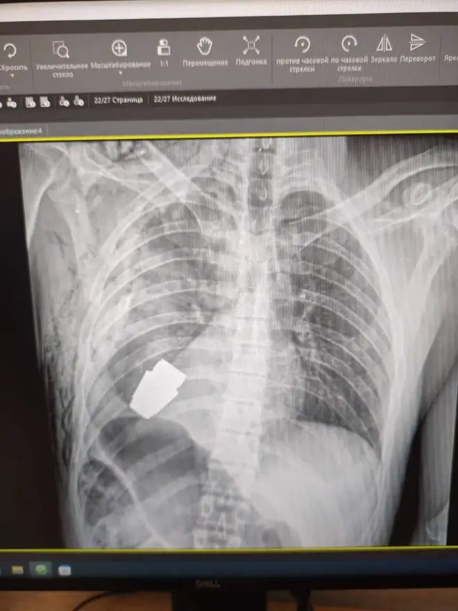 The x-ray shows the grenade lodged in the chest of the Ukrainian soldier