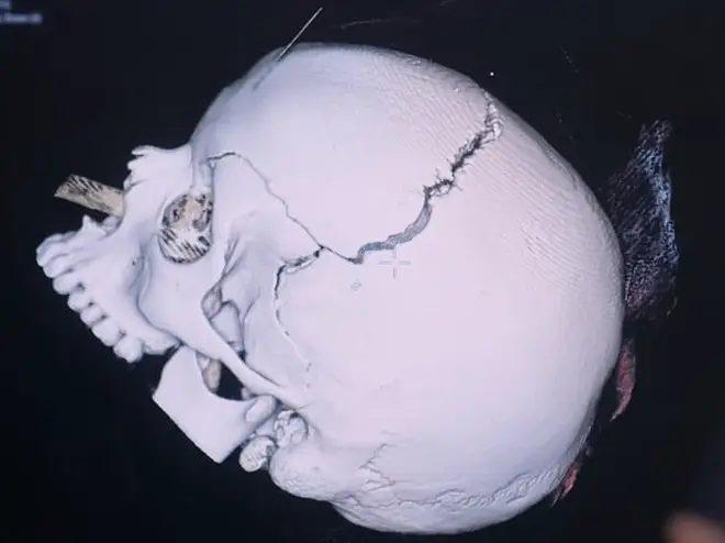 Angel's skull fracture