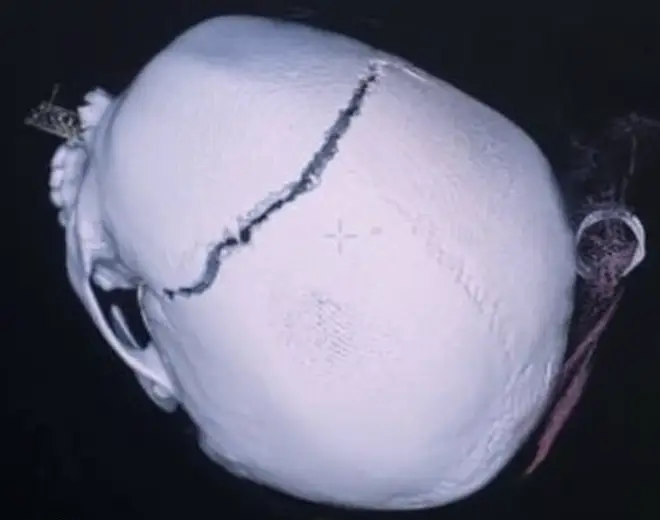 Angel's skull fracture across the top of her head