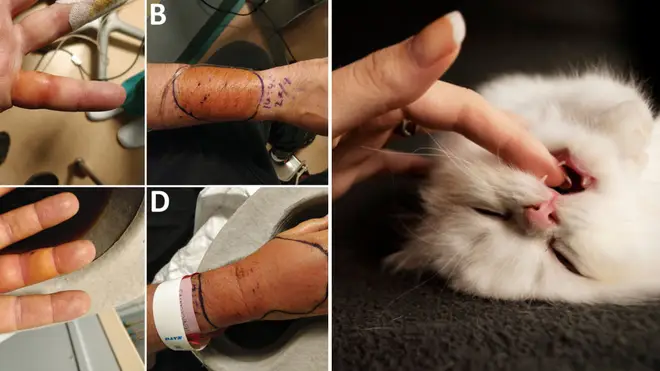 A man suffered a dangerous cat bite