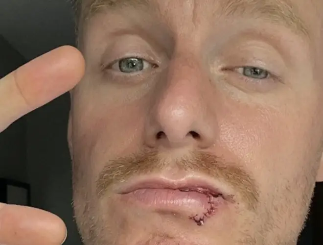 Michael Smith needed stitches in his lower lip after the attack