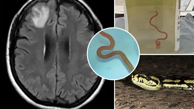 Medics discovered an 8cm worm in the woman's brain.