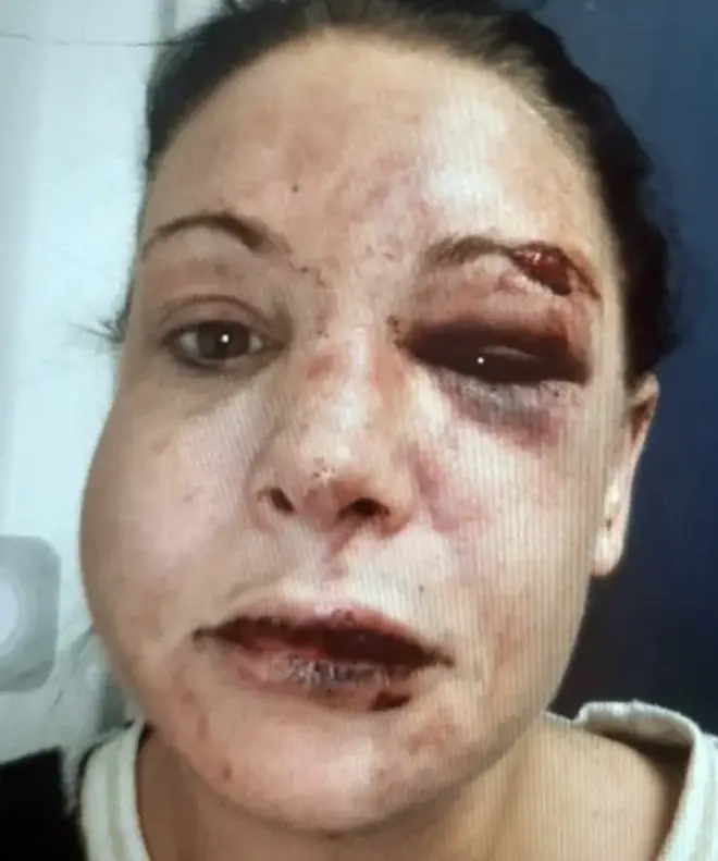 Gemma suffered horrific injuries at the hands of her abusive ex