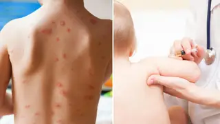 The NHS should provide chickenpox vaccines, government scientists have said