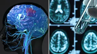 Five people are believed to have developed symptoms of the degenerative brain disease despite being aged just 38 to 55