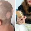 Alopecia areata is an autoimmune disease that causes hair loss through an autoimmune response 