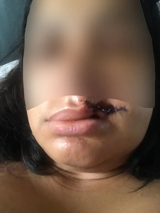The woman suffered a serious injury to her lip
