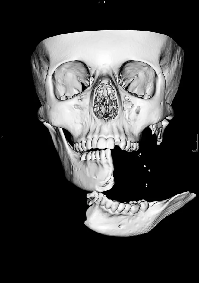 A scan of her face reveals the extent of her injuries
