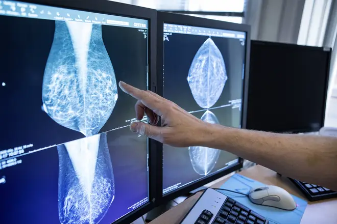 A mammography of a breast cancer patient